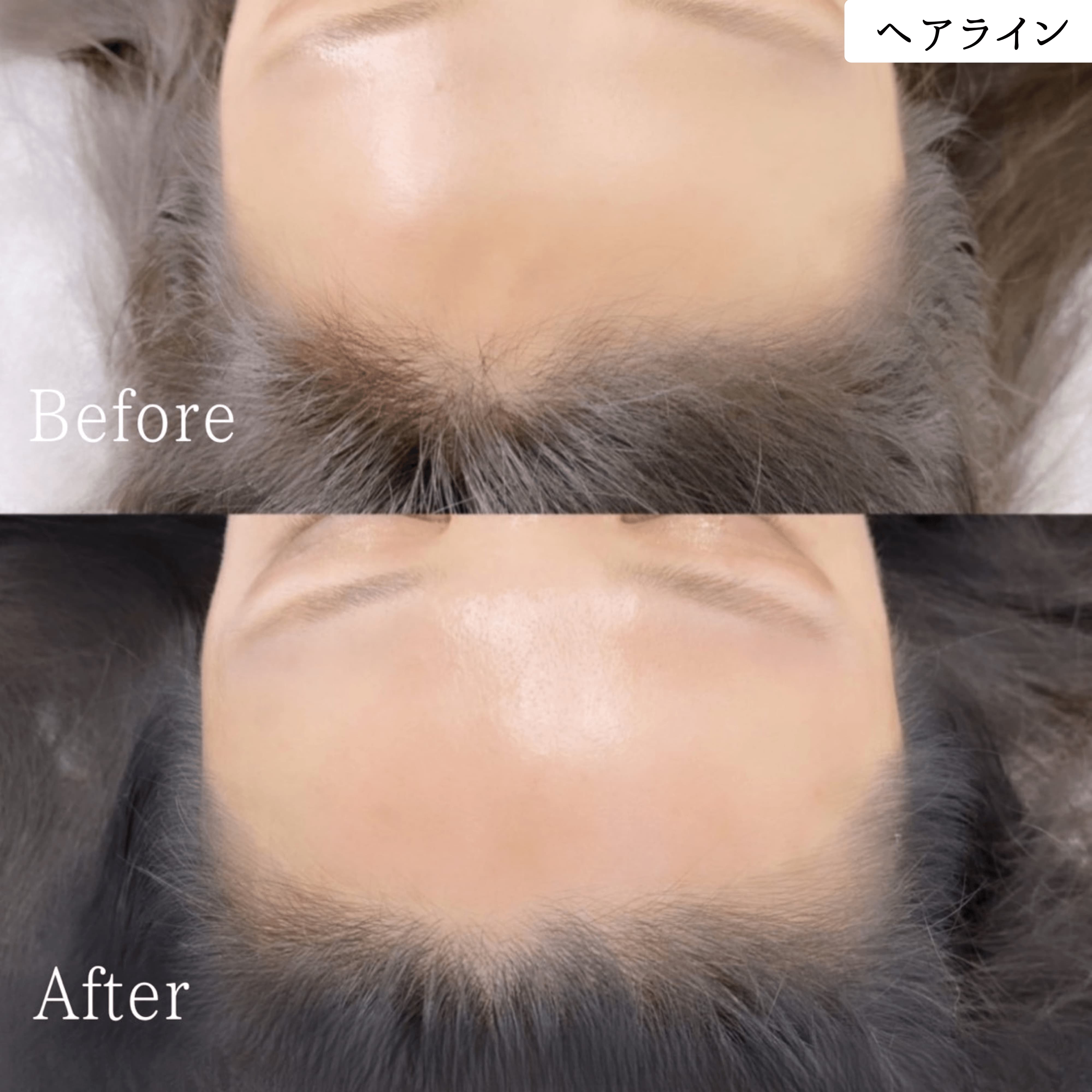 ヘアラインアートメイク 症例｜東京・半蔵門 komi