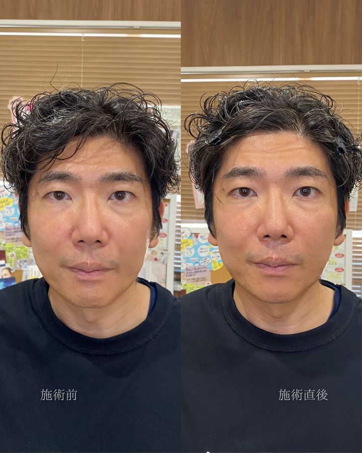 毛並み眉アートメイク 症例写真（茨城県つくば市）