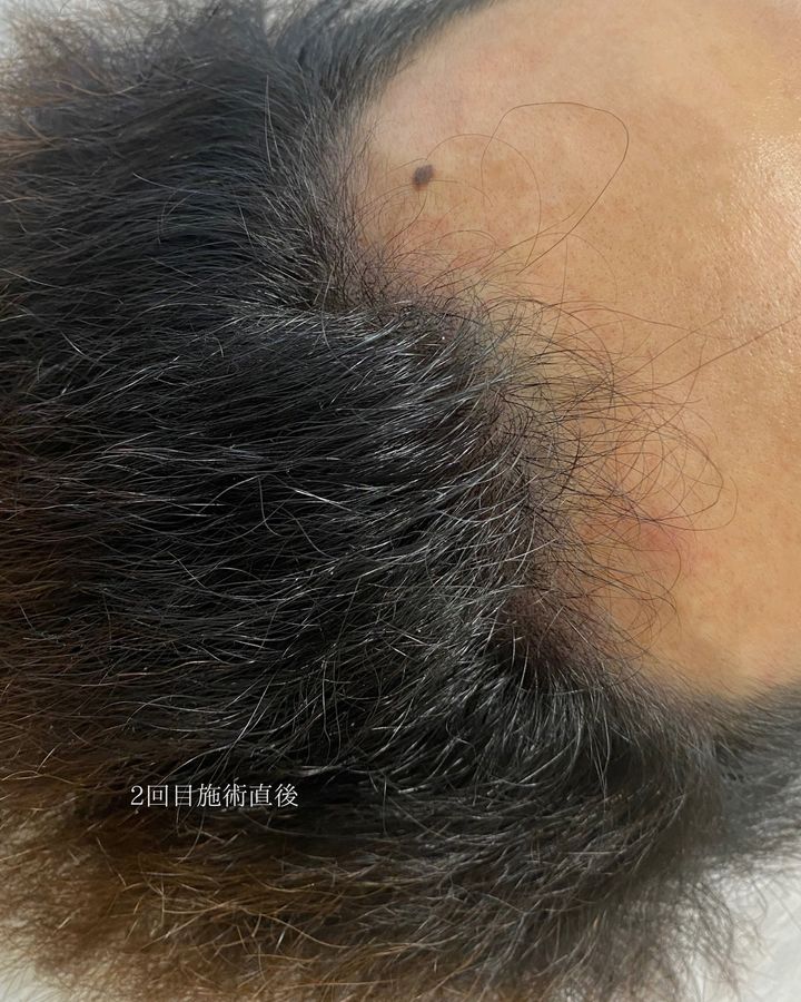 ヘアスカルプアートメイク 症例写真（群馬県）