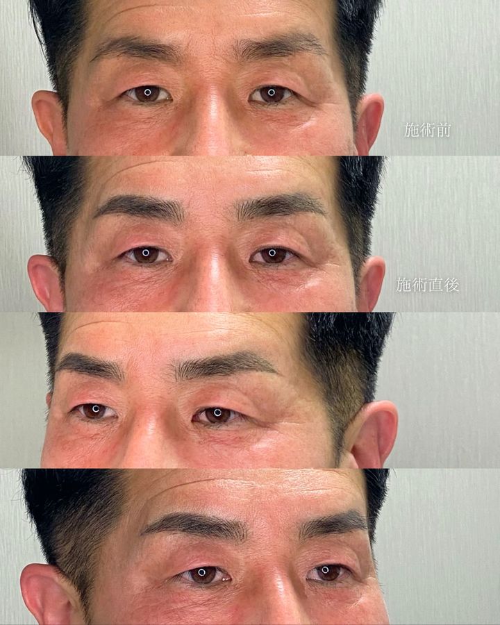 毛並み眉アートメイク 症例写真（群馬県）