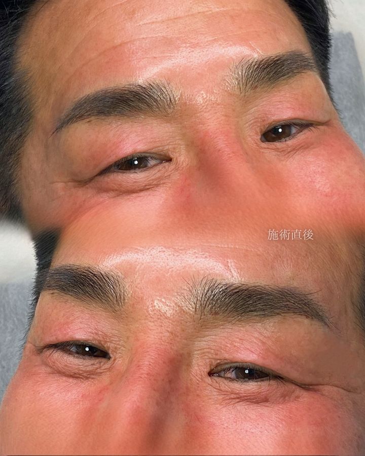 毛並み眉アートメイク 症例写真（群馬県）