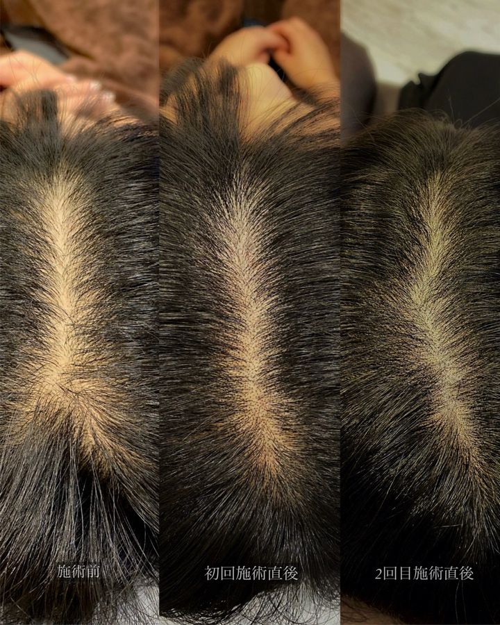 ヘアスカルプアートメイク 症例写真（香川県）