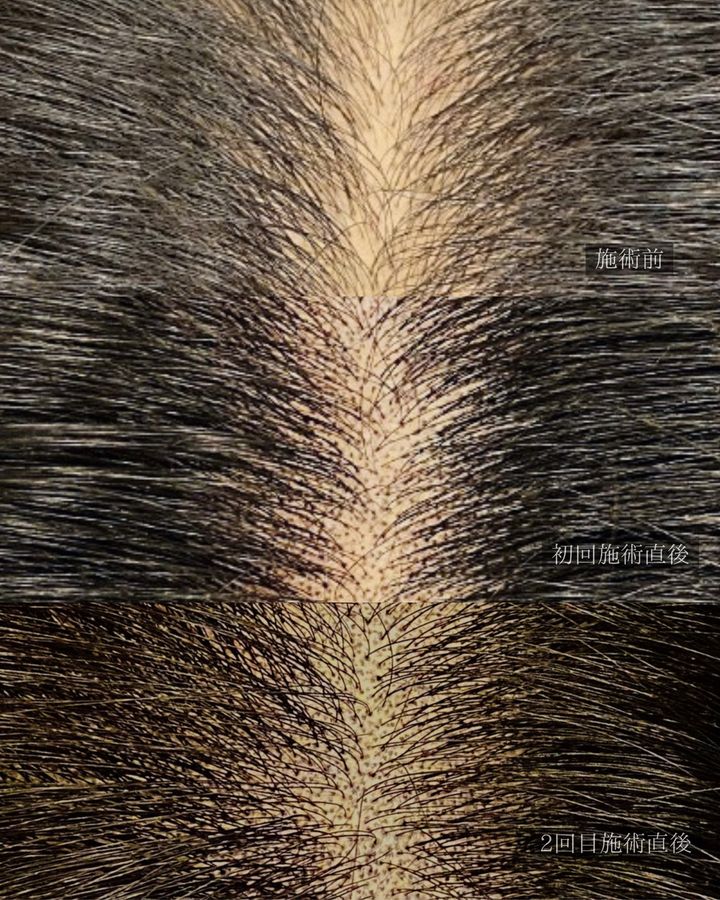 ヘアスカルプアートメイク 症例写真（香川県）