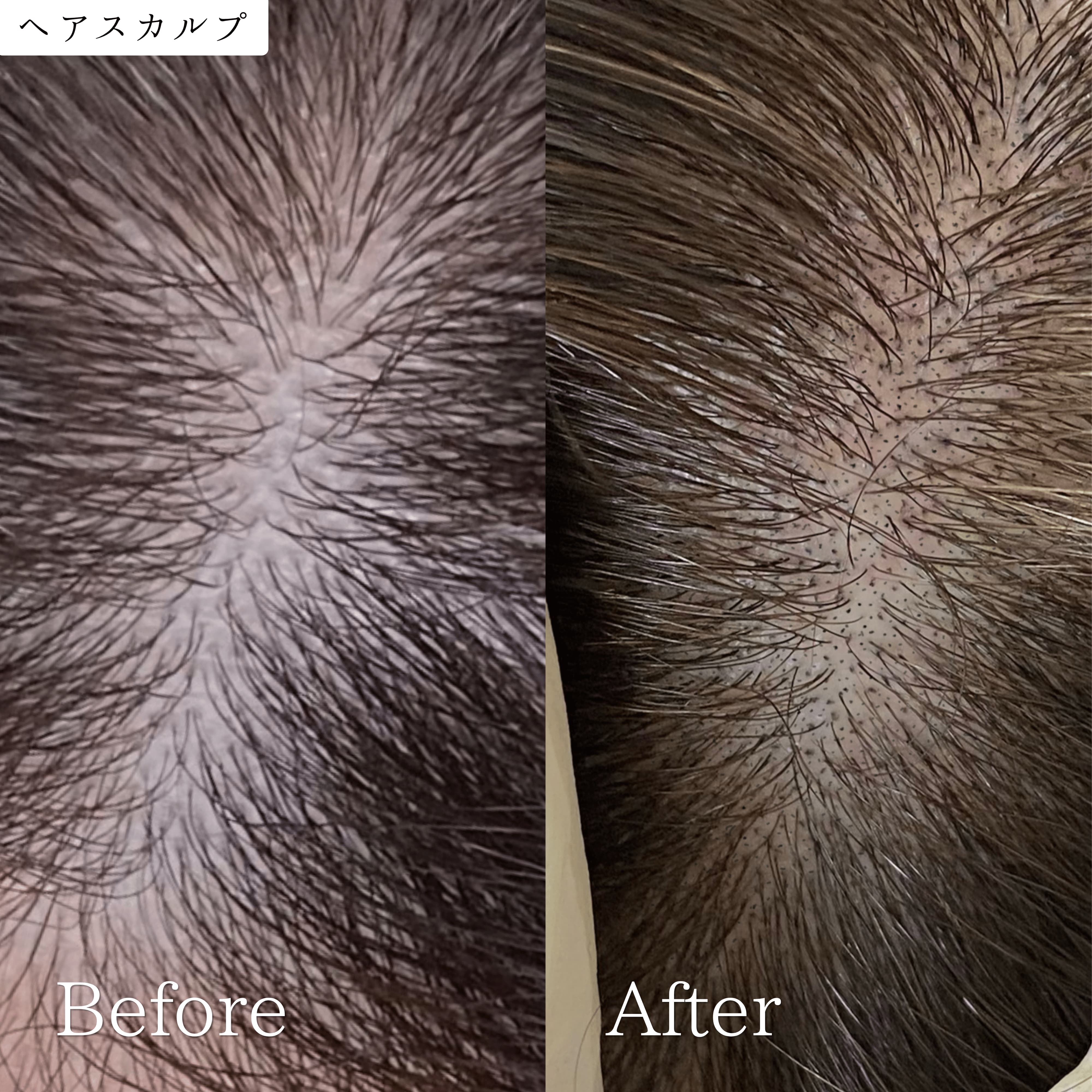 ヘアスカルプアートメイク 症例｜東京・半蔵門 komi