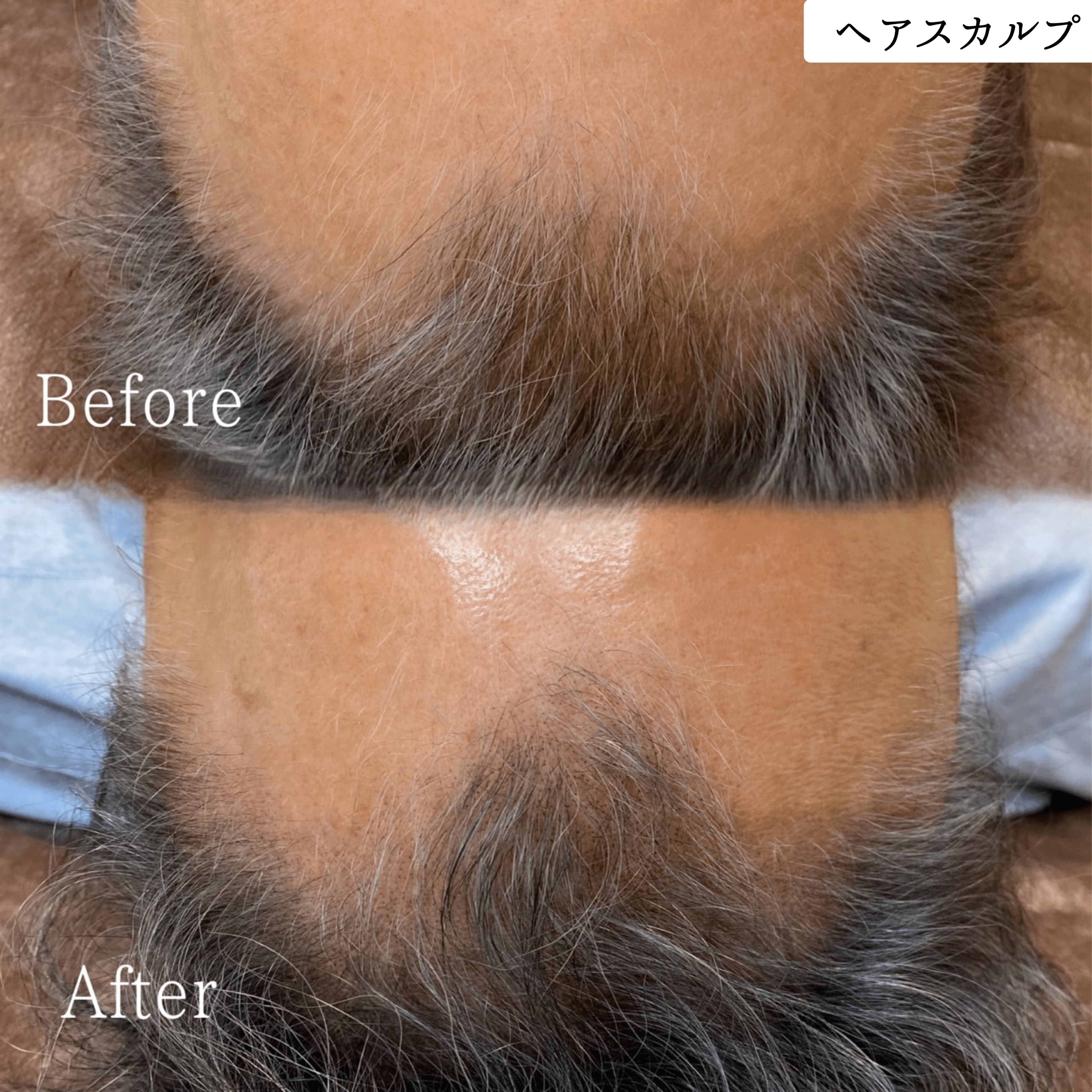 ヘアスカルプアートメイク 症例｜東京・半蔵門 komi